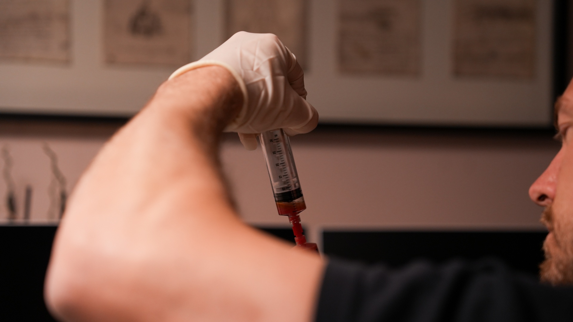 PRP preparation with syringe close-up